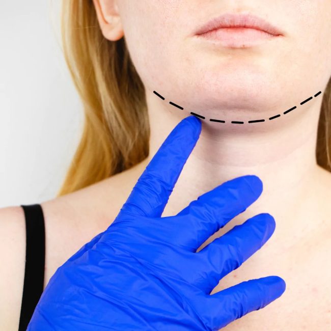 Plastic Surgery Neck Lift, Ephesus Health Group