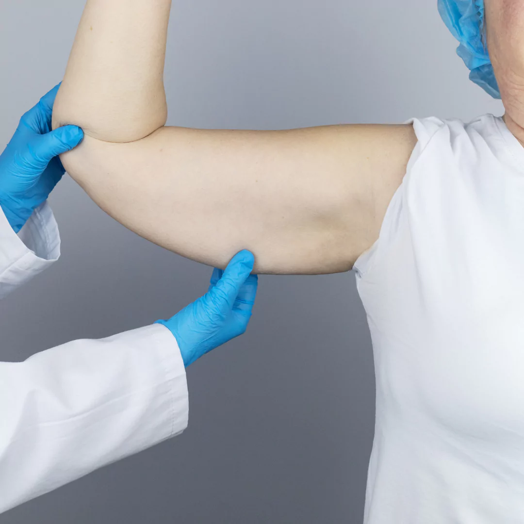 Ephesus Health Group Arm Lift Surgical Procedure